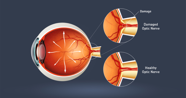 How Early Detection Affects Glaucoma Progression