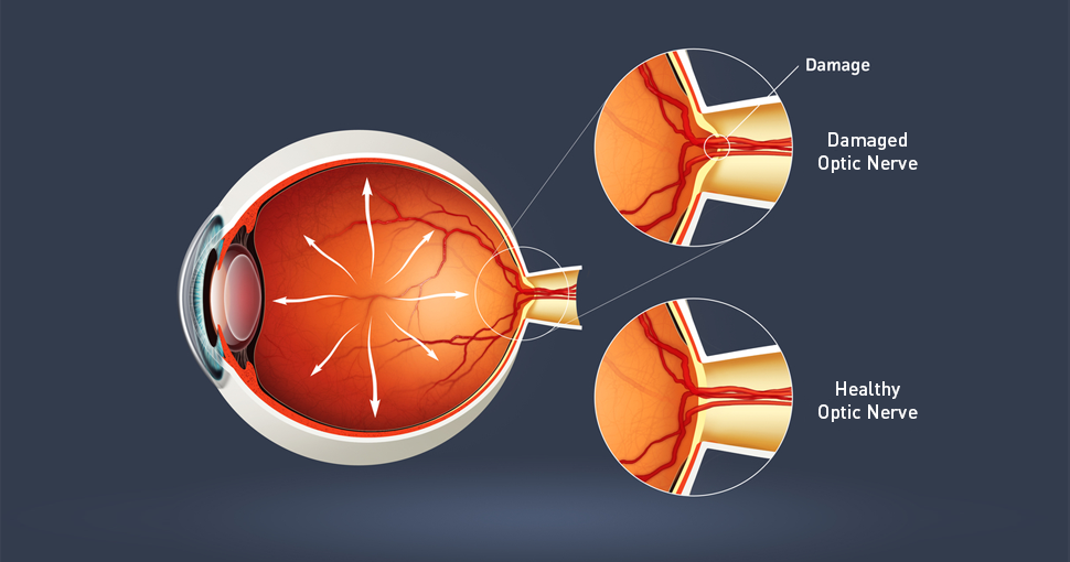 How Early Detection Affects Glaucoma Progression