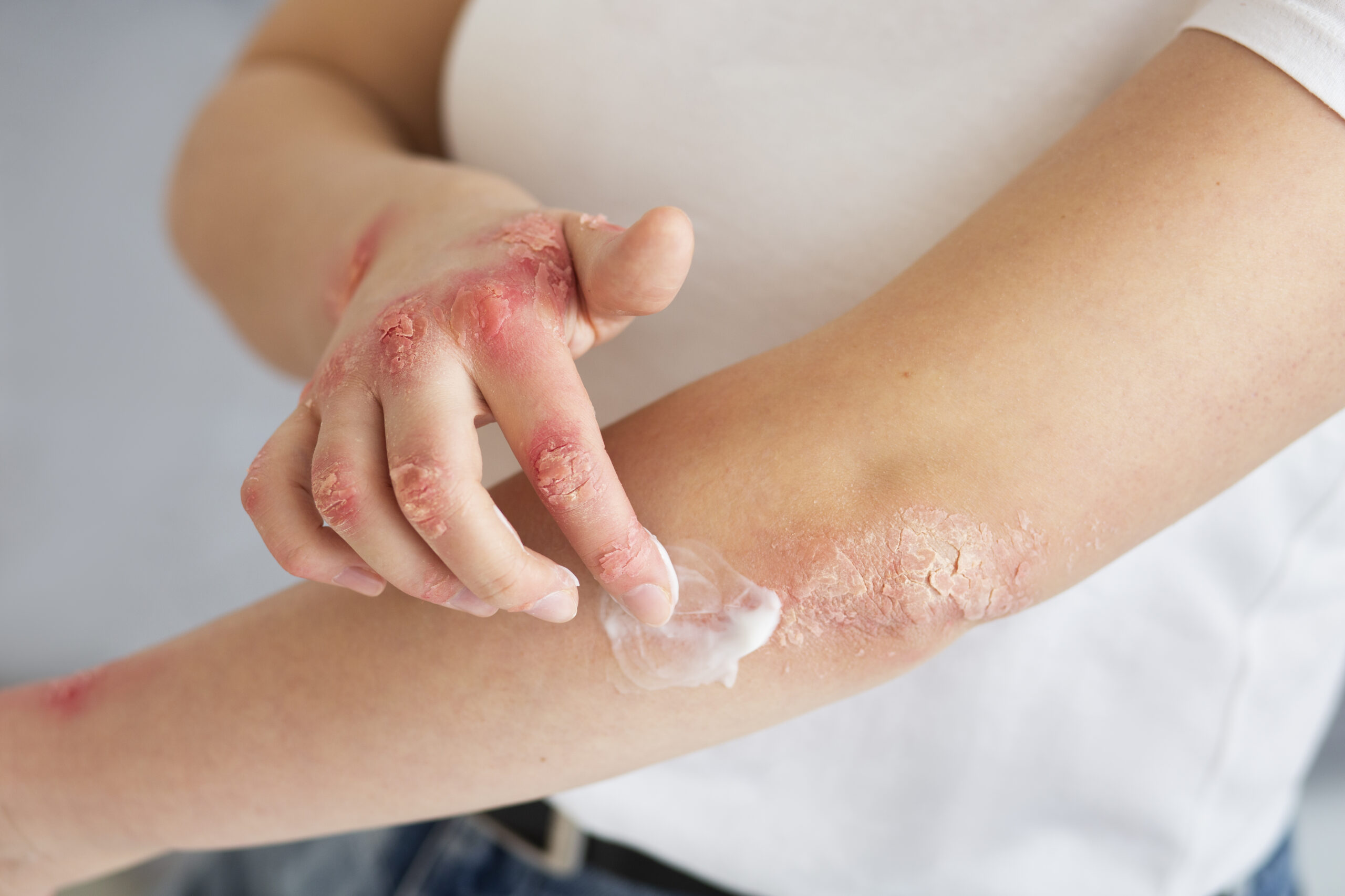 When to See a Specialist for Skin Rashes